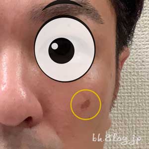 男性のシミ（老人性色素斑）の画像